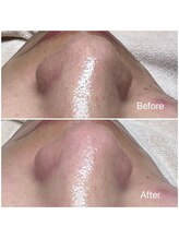 イーズ(eees)/ウルツヤ毛穴ケアで鼻の産毛ケア