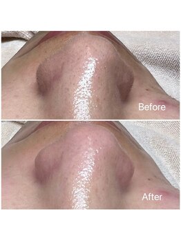 イーズ(eees)/ウルツヤ毛穴ケアで鼻の産毛ケア