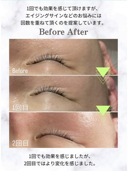 リノア 堀江(Linoa)/毛穴洗浄＆水光肌ピーリング