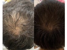 カナエル ビューティーサロン(Canael Beauty salon)/プロセルセラピーズ　2回