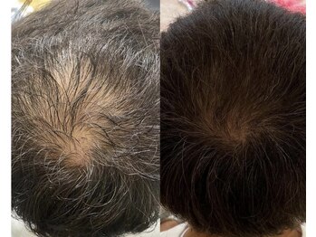 カナエル ビューティーサロン(Canael Beauty salon)/プロセルセラピーズ 2回