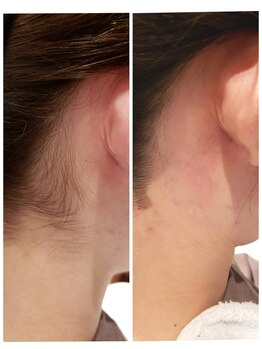 プトゥリ(Putri)/うなじWax脱毛