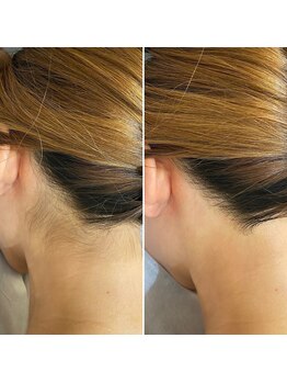 インベスト(INVEST)/うなじ脱毛