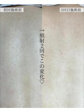 ハジュ(HAJU.)/背中脱毛の効果