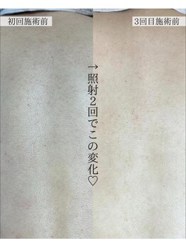 ハジュ(HAJU.)/背中脱毛の効果