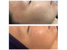 てぃーだ/毛穴の汚れとくすみが気になる方