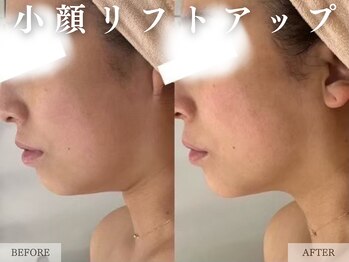 レヴェリー 心斎橋店(REVERIE)/‐ 小顔リフトアップ &nbsp;‐