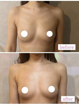 ウンスイスパ(UNSUI SPA)/バストケア　ビフォーアフター！