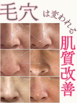 マヴィ 香里園店(MavY.)/毛穴から肌質改善!毛穴洗浄