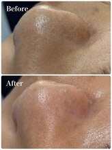 モテ 新宿店(Mote)/ハイドラ毛穴洗浄＋艶肌Wax 新宿