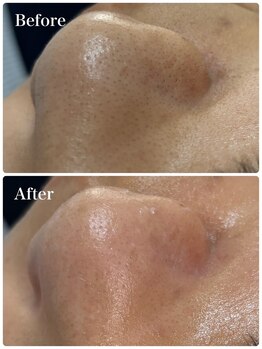 モテ 新宿店(Mote)/ハイドラ毛穴洗浄＋艶肌Wax 新宿