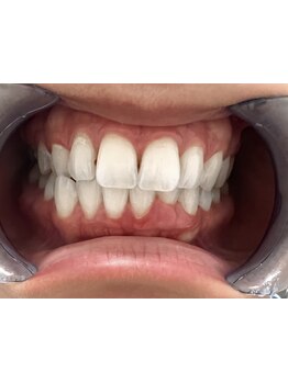 美白ケアをしたい