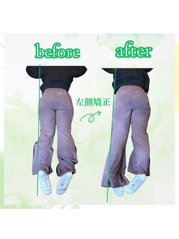 リコア(Re`core)/術後のビフォーアフター【骨盤】