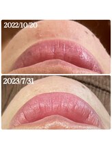 オーノ(Ohno)/【ニキビ・唇色素改善】マツヤニ