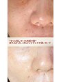 ソワ 吉塚店(soi)&nbsp;肌質改善 逆戻りケア