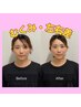 美容サロンで！小顔矯正｜たるみ・むくみ・左右差も整える美フェイスライン