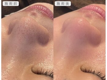 アンノウン 姫路店(Unknown.)の写真/【ハイドロピーリング毛穴洗浄】話題の毛穴ピーリングで透明感UP◎毛穴の黒ずみ・ごわつき・いちご鼻に♪