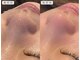 アンノウン 姫路店(Unknown.)の写真/【ハイドロピーリング毛穴洗浄】話題の毛穴ピーリングで透明感UP◎毛穴の黒ずみ・ごわつき・いちご鼻に♪