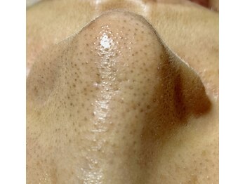 プリエ(PRIER)の写真/こんな毛穴になってませんか？毛穴の開きとブラックヘッドをケアしてすっきりキレイな毛穴へ♪