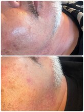 リコリナ(LikoLina)/ひげ脱毛