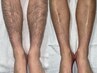 《男女共通》脚全体脱毛（太もも表裏・膝・脛・甲・指）　¥4000