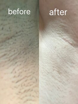 アイビークイーン(I.B.QUEEN)/剃らないで１か月以上