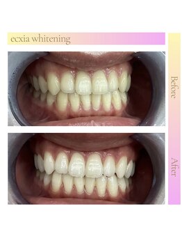 エクシアホワイト 新宿御苑店(ecxia white)/ホワイトニングビフォーアフター