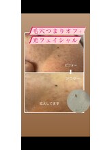 エステスタジオ アキコ(AKIKO)/毛穴ケア