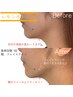 【ダウンタイム無◆脂肪分解】レモンボトル2cc ￥13,000→￥10,000