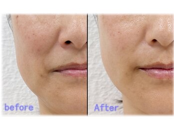 メディカルフェイシャルエステティック サロン ド ヴェリテ(VERITE)/ソフトダーマ 50代 3回