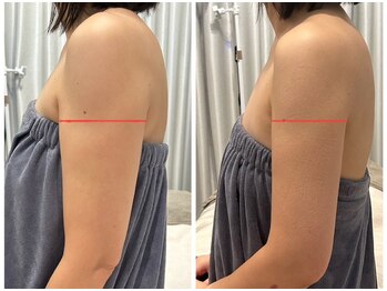ラピスラズリの写真/自己ケアで落ちない二の腕・背中・ハミ肉…美容機器×リンパケアでしっかり細くしたい！