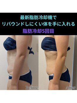 ホワイトビューティーラボ(White Beauty Lab)/【痩身】腹部モニター５回目