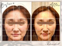 トーティシェル(tortoise shell)/1回の施術で効果バツグン！