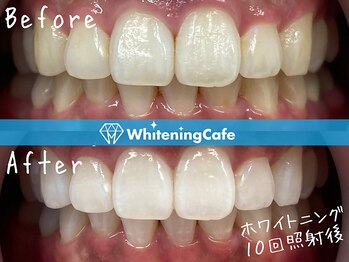 ホワイトニングカフェ 札幌東急百貨店(WhiteningCafe)/ホワイトニングビフォーアフター