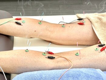 とだ鍼灸院の写真/《末端~全身の冷えは鍼で解決◎》毎年冷えに悩まされている方も鍼施術で体を変えていきましょう♪