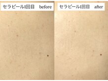 エリュレ(Elyure)/セラピール