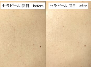 エリュレ(Elyure)/セラピール