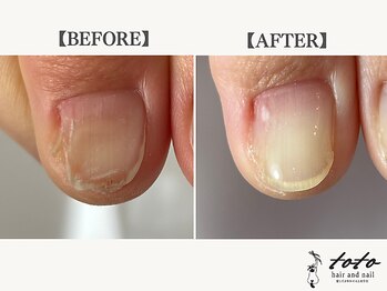 トトヘアー アンド ネイル(toto hair and nail)/変形したお爪の改善例