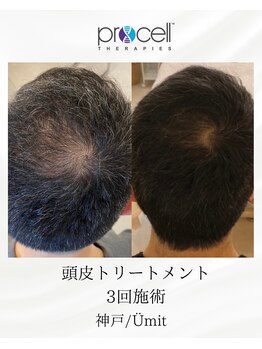 ユミト(Umit)/プロセルスカルプ