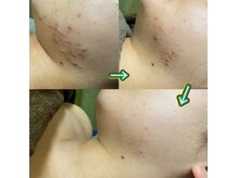 ナチュウル(Natulu)の雰囲気（お肌改善/ ダクトピール5カ月10回施術/お肌の中から整う！）