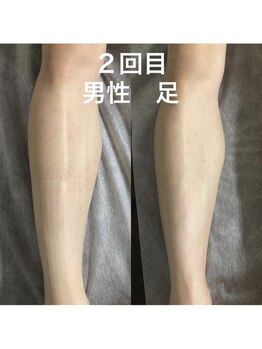 アイビークイーン(I.B.QUEEN)/男性の強い毛も