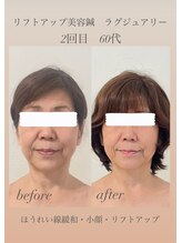 めい鍼灸院/美容鍼灸　ビフォーアフター