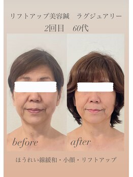 めい鍼灸院/美容鍼灸 ビフォーアフター