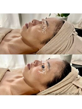 サロン ド ブラン アオヤマ(Salon de BLANC AOYAMA)/トーンup&リフトup！