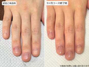 カピリナ(Ka Pilina)/自爪育成・川崎・深爪