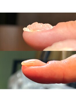 キュア(Cure.)/いじり癖の爪の自爪育成ジェル