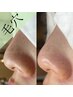 【季節フェイシャル】毛穴エクストラクション(鼻のみ)×グローパック60分