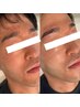 【男性・毛穴すっきり】黒ずみ、開き解消！毛穴による清潔感◎14900→12900