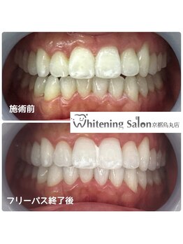 ホワイトニングサロン 京都烏丸店/ホワイトニング施術例