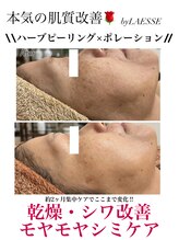 ココネイル 板山店(coco nail)/ハーブピーリング×ポレーション